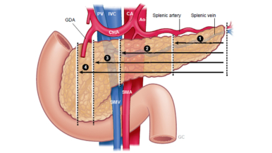 Standardizing definitions and terminology of left-sided pancreatic resections through an international Delphi consensus