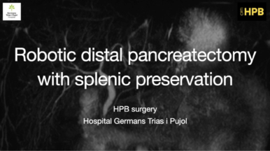 Pancreatectomia distal robótica con preservación esplénica