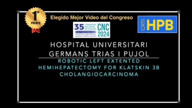 Hepatectomía Izda robótica con resección de vena porta por colangiocarcinoma hiliar Klatskin IIIb