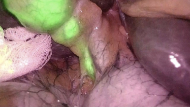 Dose and administration time of indocyanine green in near-infrared fluorescence cholangiography during laparoscopic cholecystectomy (DOTIG): study protocol for a randomised clinical trial.