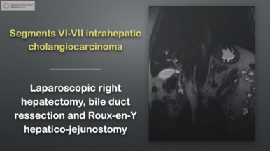 Hepatectomía derecha laparoscópica y hepatico-yeyunostomía en Y-Roux por colangiocarcinoma.