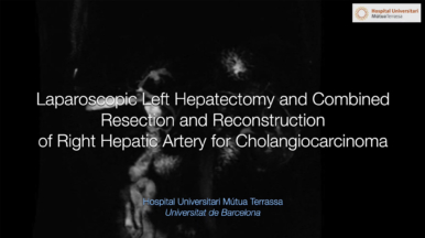 Hepatectomía izquierda laparoscópica con reconstrucción de artería hepática derecha por colangiocarcinoma.