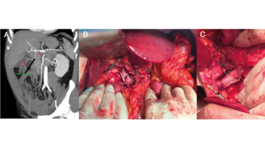 Injerto autólogo de vaina posterior de músculo recto del abdomen para la reconstrucción vascular del confluente espleno-mesentérico-portal en cirugía pancreática