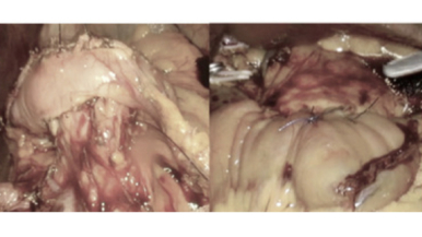 Pancreas anastomosis after laparoscopic and robotic pancreatoduodenectomy.