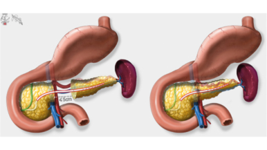 Minimally invasive versus open central pancreatectomy: Systematic review and meta-analysis