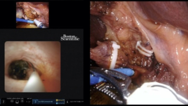 Robotic cholecystectomy and transcystic common bile duct exploration with augmented reality glasses and indocyanine green in a patient with a cystic duct cyst.