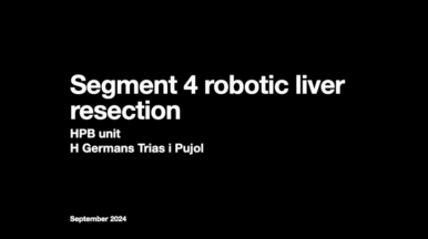 Segment 4 robotic liver resection