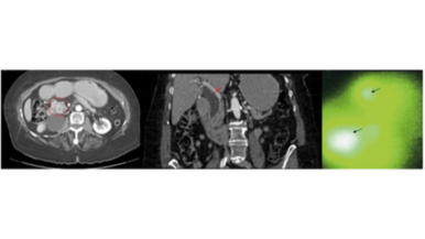 Detection of the sentinel node in pancreatic cancer by fluorescence imaging.