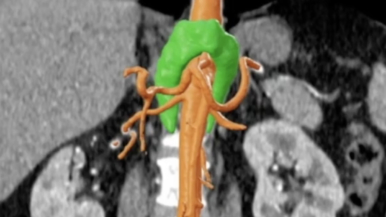 Surgical treatment of the Median Arcuate Ligament Syndrome (MALS) using robotic platform.